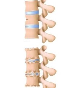Osteochondrozės priežastys