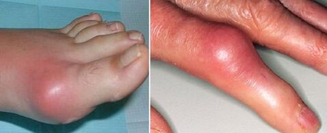 sąnarių atsiradimas su artritu