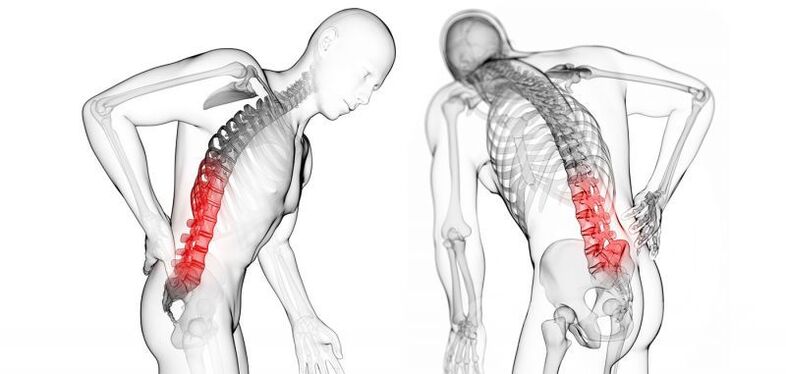 gimdos kaklelio osteochondrozės komplikacijos