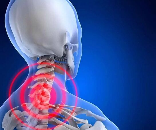 Gimdos kaklelio osteochondrozė